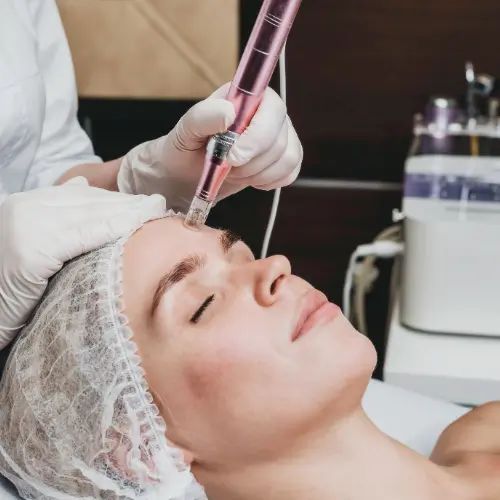 Dermapen kezelés Szegeden, tűs mezoterápia az arcon